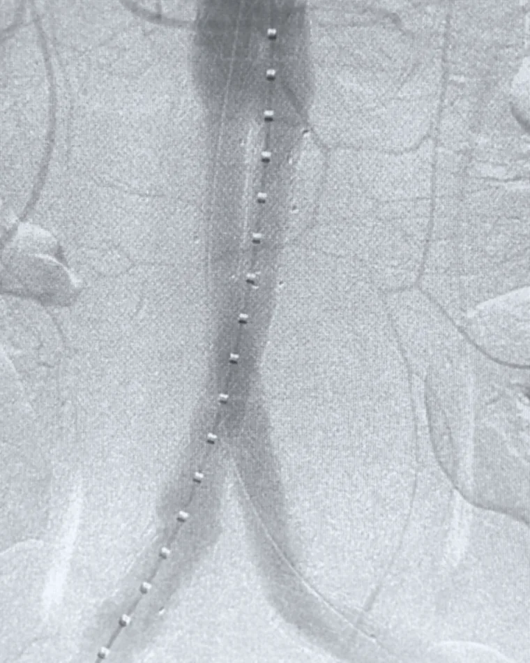 Angiografia em tons de cinza: a endoprótese, marcada por pontos brancos, por dentro da aorta e da bifurcação das artérias