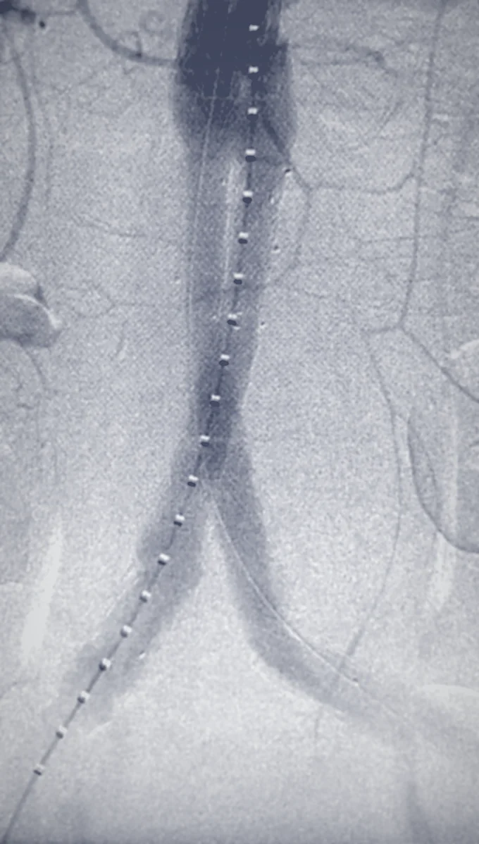 Angiografia real em tons de prata: a aorta e as artérias das pernas, com os pontos brancos da endoprótese colocada por dentro do vaso